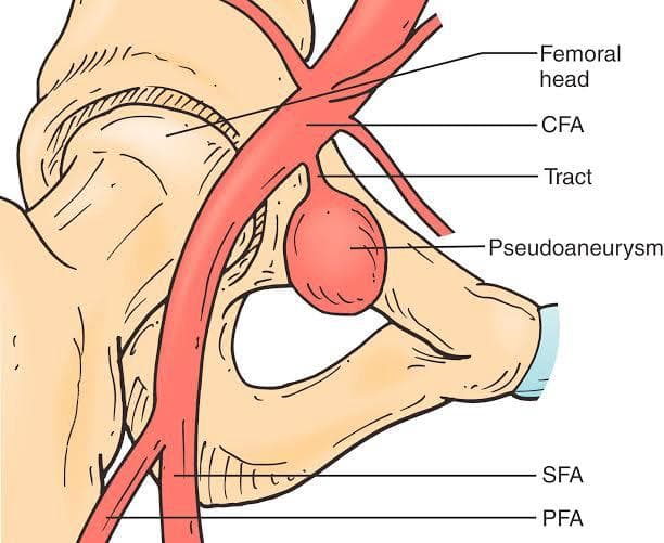 Aneurysms & Pseudoaneurysms