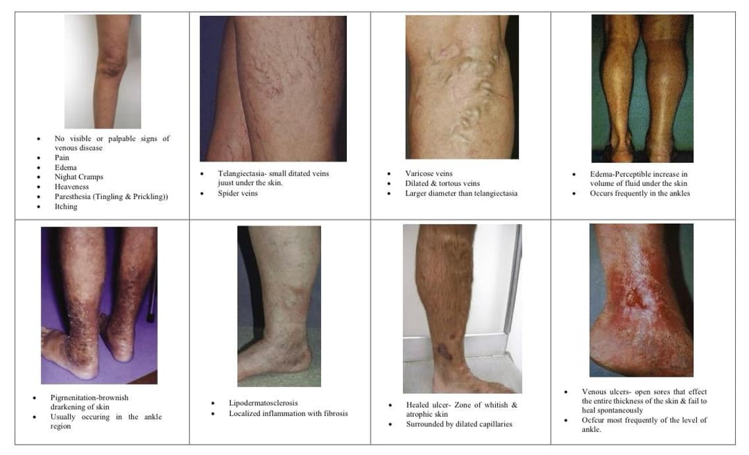 Chronic venous diseases