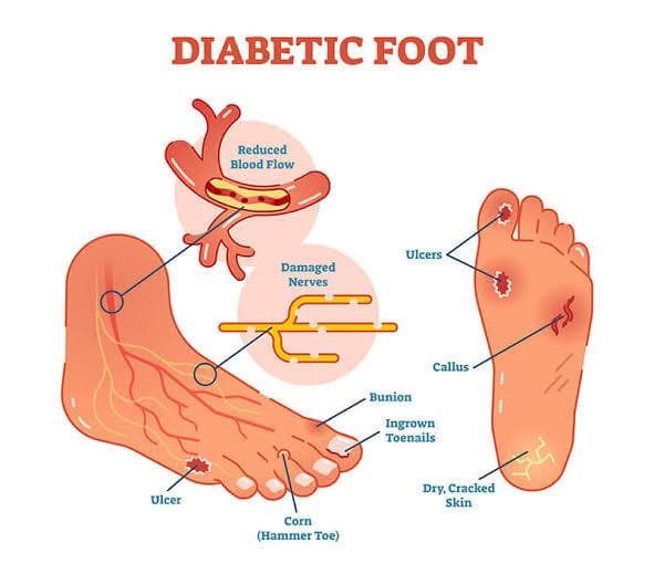 Chronic Diabetic Foot Ulcers