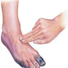 Chronic Limb Threatening Ischemia ( CLTI )