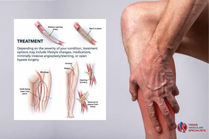 Peripheral arterial occlusive disease (PAOD)