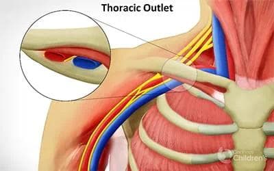 Thoracic Outlet Syndrome