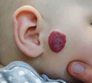 Vascular Tumors & Malformations