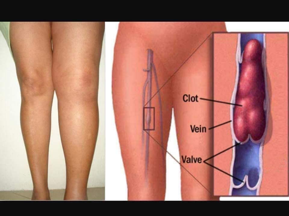 Deep Vein Thrombosis (DVT)