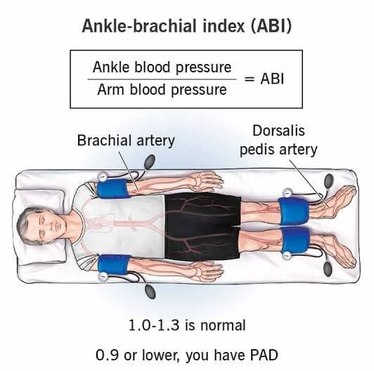 ABPI (Ankle-Brachial Pressure Index) For Vascular Assessment
