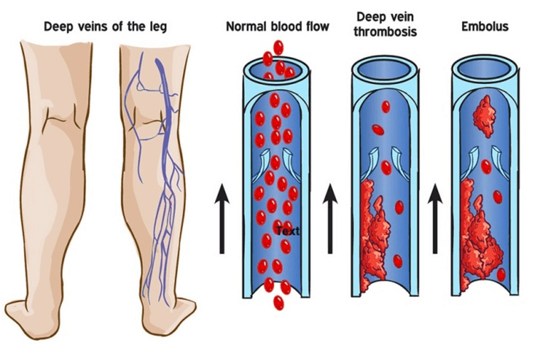 DVT Example