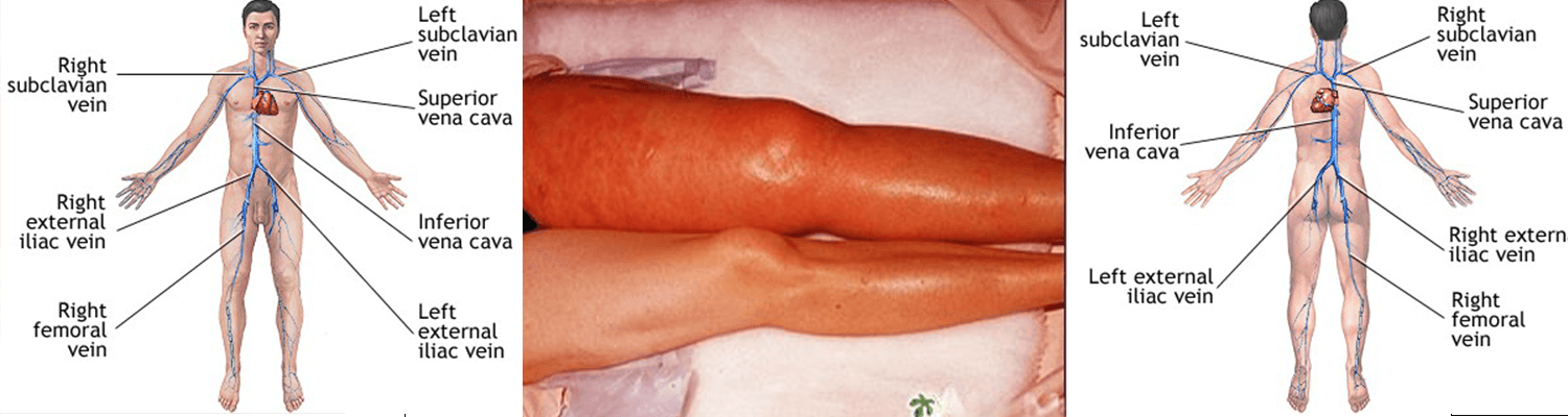 Deep Vein Thrombosis (DVT)