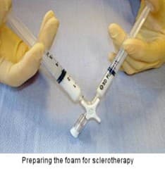 Varicose Vein Example 1