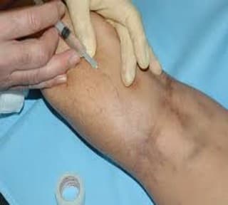 Varicose Vein Example 2