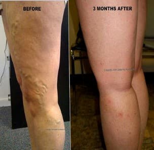 Varicose Vein Example 3