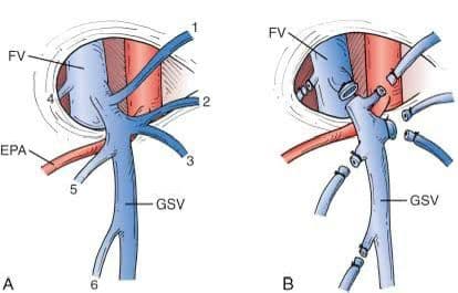 Varicose Veins Surgery