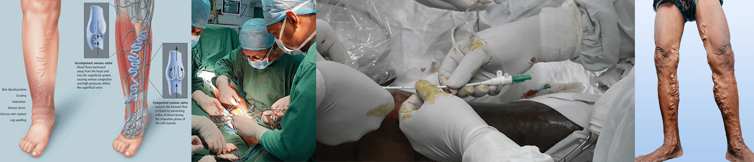 Varicose Veins